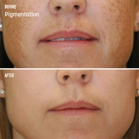 VI Peel Treatments - Before and After