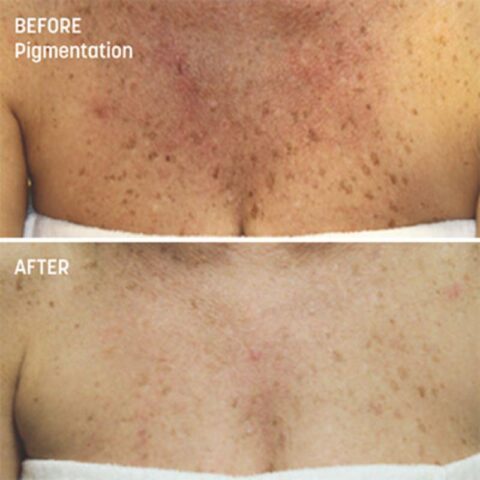 VI Peel Treatments - Before and After