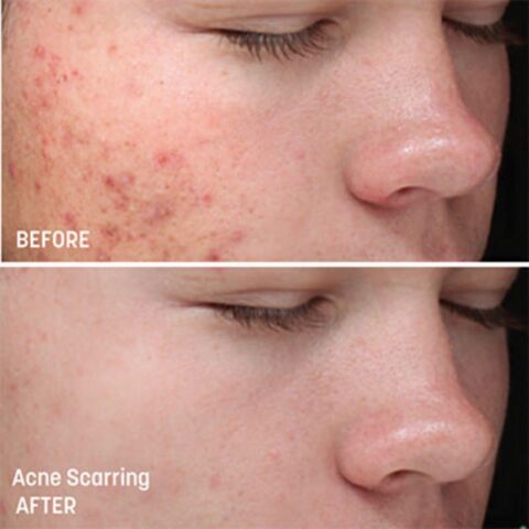 VI Peel Treatments - Before and After