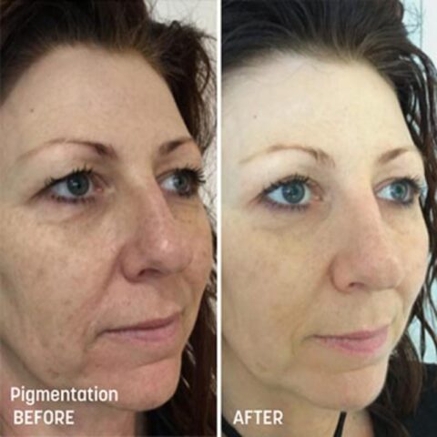 VI Peel Treatments