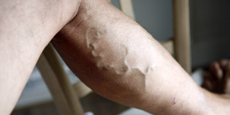 What are Varicose Veins? Understanding Vein Health and Professional Treatment Solutions