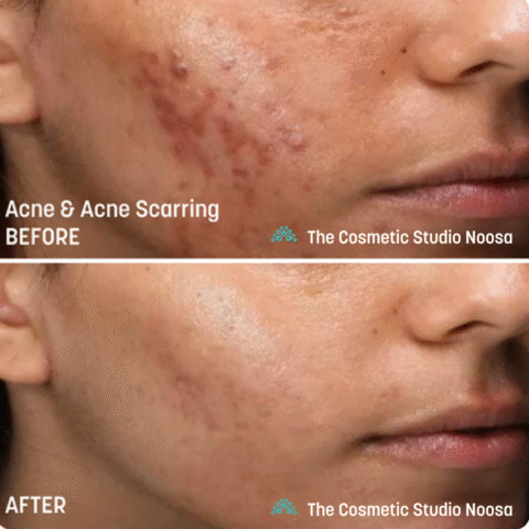 Dermapen Skin Needling