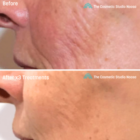 GENIUS RF Treatment Packages